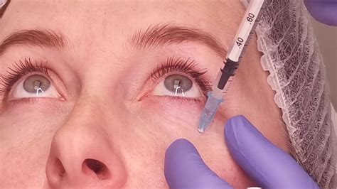 under eye bag treatment dermatologist